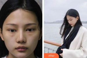 福州中聯(lián)美康整形美容醫(yī)院林琳整形價格表附內(nèi)切祛眼袋案例展示