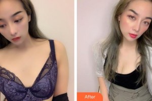 福州隆美爾整形美容醫(yī)院郭志輝 整形價格表附假體豐胸案例展示