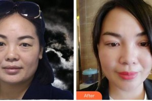 福州海峽美容醫(yī)院陳藝清整形價格表附不開刀雙眼皮案例展示