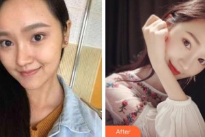 福州藝美醫(yī)療整形美容診所郭秀清整形價格表附多方面部埋線提升-埋線提升提升案例展示