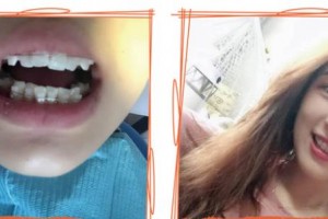 福州海峽美容醫(yī)院柳書喻整形價格表附隱形托槽矯正案例展示