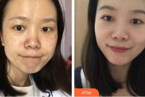 福州海峽美容醫(yī)院張光澤整形價格表附超激光美膚祛斑案例展示