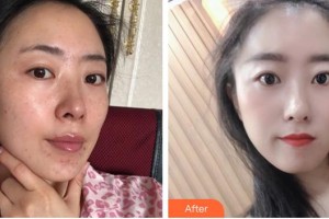 福州愛美爾整形美容醫(yī)院魏芳整形價(jià)格表附激光美膚激光案例展示