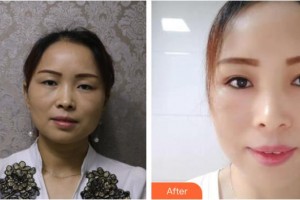 福州中聯(lián)美康整形美容醫(yī)院蔡群整形價(jià)格表附切開雙眼皮案例展示