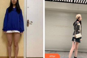 福州臺江醫(yī)院整形美容中心金永圭整形價(jià)格表附大腿吸脂案例展示