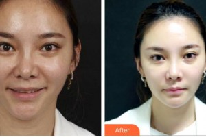 福州臺江醫(yī)院整形美容中心蕭長雄整形價(jià)格表附抗衰案例展示