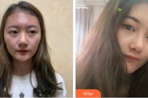福州隆美爾整形美容醫(yī)院張履興整形價(jià)格表附鼻部綜合案例展示
