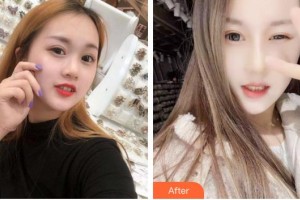 福州愛思特比華利整形美容醫(yī)院劉耀美整形價(jià)格表附眼部手術(shù)案例展示