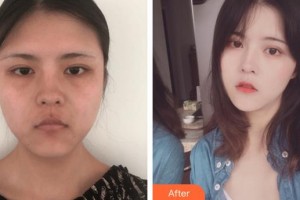 福州美萊華美美容醫(yī)院曾德朋整形價格表附埋線提升案例展示