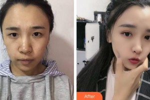 福州秀清醫(yī)療美容診所周鎮(zhèn)龍整形價格表附眼部整形案例展示