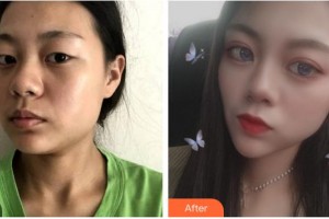 福州臺江醫(yī)院整形美容中心馬美洲整形價格表附眼部綜合案例展示