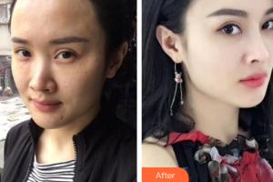 廣州尚美善造美容醫(yī)院李瓊整形價格表附熱瑪吉頸部體驗案例展示