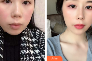 廣州華醫(yī)醫(yī)療美容門診部鐘學(xué)成整形價格表附耳軟骨復(fù)合隆鼻案例展示