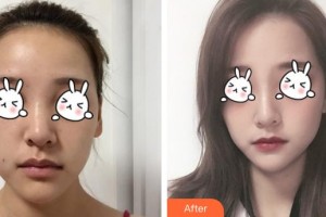 福州美萊華美美容醫(yī)院陳力楊整形價格表附下巴注射結(jié)合嗨體、線材改良嘟案例展示