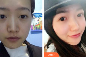 廣州基立嘉韓醫(yī)學(xué)整形美容醫(yī)院黃軍彬整形價格表附眼部整形案例展示