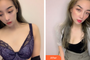 廣州華醫(yī)醫(yī)療美容門診部鄒大維整形價格表附自體脂肪隆胸案例展示