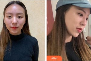 福州臺江醫(yī)院整形美容中心李文信整形價(jià)格表附隆鼻案例展示