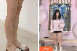 廣州基立嘉韓醫(yī)學(xué)整形美容醫(yī)院林彩環(huán)整形價格表附增生疤痕案例展示