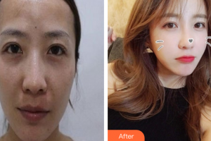 廣州基立嘉韓醫(yī)學(xué)整形美容醫(yī)院杜欣逸整形價格表附自體脂肪全臉填充案例展示