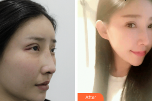 廣州基立嘉韓醫(yī)學(xué)整形美容醫(yī)院楊國華整形價(jià)格表附雙眼皮修復(fù)案例展示