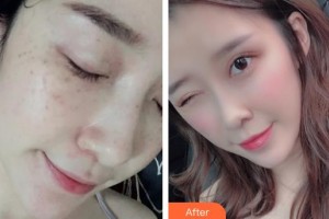 福州海峽美容醫(yī)院林秀蘭整形價(jià)格表附眼部手術(shù)案例展示