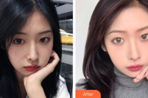 福州臺江醫(yī)院整形美容中心路世敏整形價格表附熱瑪吉案例展示