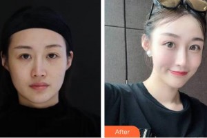 福州格萊美醫(yī)療美容醫(yī)院官玉貞整形價(jià)格表附熱瑪吉抗衰案例展示