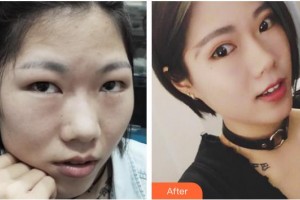 福州格萊美醫(yī)療美容醫(yī)院鄭海鎮(zhèn)整形價(jià)格表附切開(kāi)雙眼皮案例展示