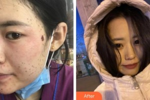 福州愛(ài)美爾整形美容醫(yī)院謝楠整形價(jià)格表附超激光美膚祛斑案例展示