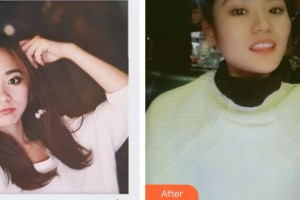 福州市第八人民醫(yī)院整形美容科王存福整形價(jià)格表附金屬托槽矯正案例展示