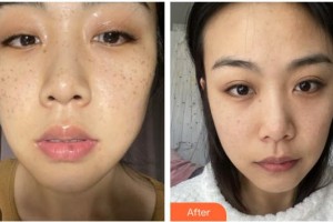 福州臺(tái)江醫(yī)院整形美容中心潘桂蘭整形價(jià)格表附激光美膚祛斑案例展示