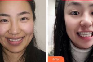 福州維樂(lè)口腔門(mén)診部郭淑蘋(píng)整形價(jià)格表附隱形矯正案例展示