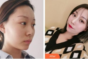 福州市第八人民醫(yī)院整形美容科王世健整形價格表附抗衰案例展示