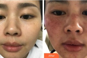 福州愛(ài)思特醫(yī)療美容醫(yī)院鄭榕整形價(jià)格表附超激光美膚案例展示