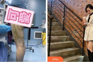 福州格萊美醫(yī)療美容醫(yī)院米契爾.高德曼整形價(jià)格表附吸脂案例展示