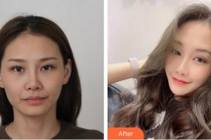 福州名韓整形美容醫(yī)院李陽整形價格表附DA·面部脂肪填充案例展示