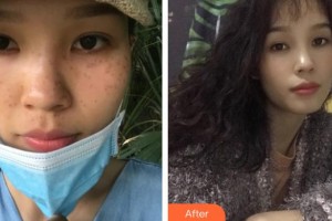 福州華窈渙美整形美容醫(yī)院劉麗麗整形價格表附祛斑案例展示