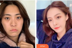 福州匯美整形美容醫(yī)院游家偉整形價格表附抗衰老案例展示