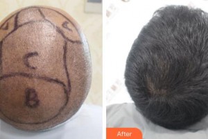 福州百紜凱曼醫(yī)療整形門診部張學進整形價格表附頭發(fā)種植案例展示