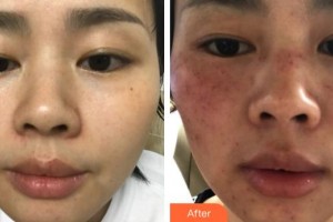 福州藝美醫(yī)療整形美容診所何卉整形價格表附超激光美膚案例展示