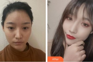 福州市第八人民醫(yī)院整形美容科談偉佳整形價格表附發(fā)際線種植案例展示