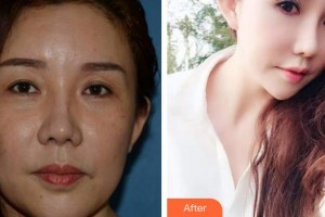 福州優(yōu)美醫(yī)療美容診所高祥整形價(jià)格表附眼周年輕化案例展示