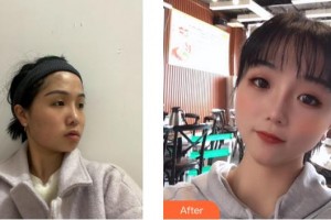 福州海峽美容醫(yī)院王強(qiáng)整形價(jià)格表附埋線提升提升案例展示