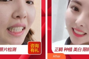 福州華窈渙美整形美容醫(yī)院張文洪整形價(jià)格表附牙齒做美容案例展示