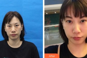 福州市鼓樓醫(yī)院整形美容中心張晘理整形價(jià)格表附眼部手術(shù)案例展示