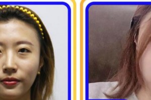 福州海峽美容醫(yī)院薛克墘整形價(jià)格表附眼部綜合案例展示