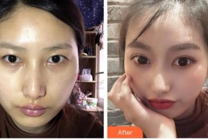 福州美貝爾醫(yī)療美容門(mén)診部趙棟材整形價(jià)格表附全切雙眼皮案例展示