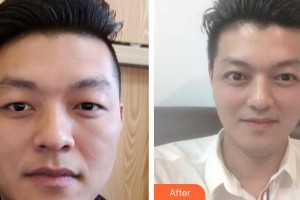 福州美貝爾醫(yī)療美容門(mén)診部張曉棠整形價(jià)格表附即變男神，無(wú)關(guān)痛癢案例展示