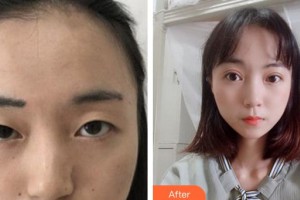 福州名韓整形美容醫(yī)院察鵬飛整形價(jià)格表附雙眼皮案例展示
