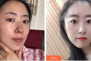 福州名韓整形美容醫(yī)院彭鳳嬌整形價(jià)格表附激光美膚激光案例展示